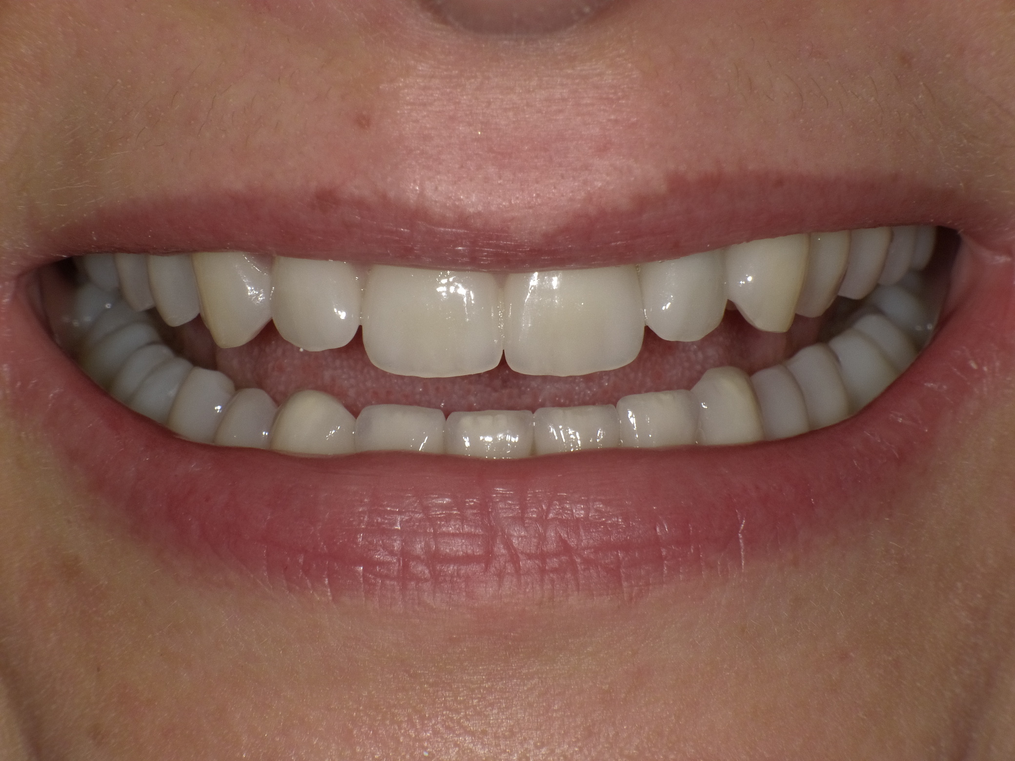 Komplettbehandlung und ästhetische Optimierung in nur 2 Langzeitterminen mit Kronen und Veneers aus Vollkeramik